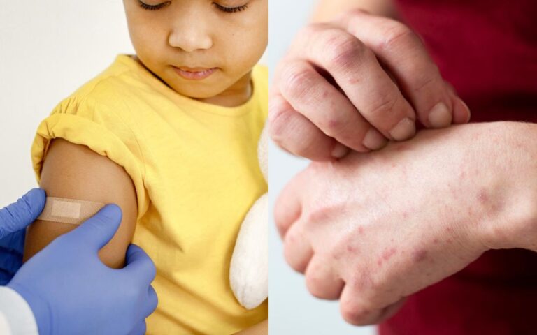 Alerta por brote de Sarampión: mitos ponen en peligro la salud de miles de personas