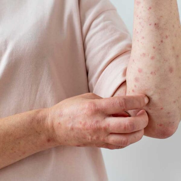 Preocupa brote de sarampión en Arizona y Utah