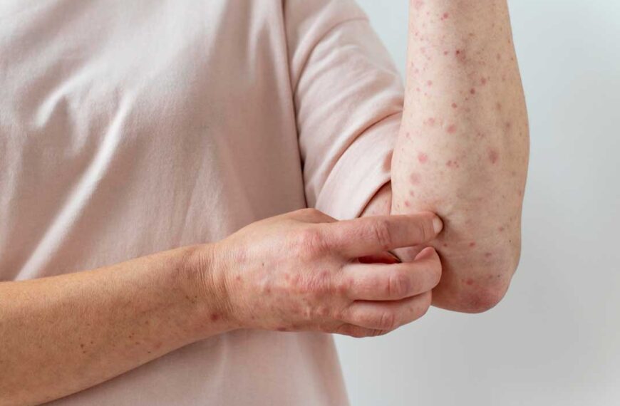 Preocupa brote de sarampión en Arizona y Utah