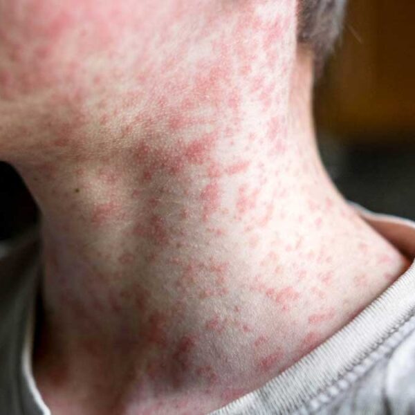 Alarmante brote de sarampión en Arizona