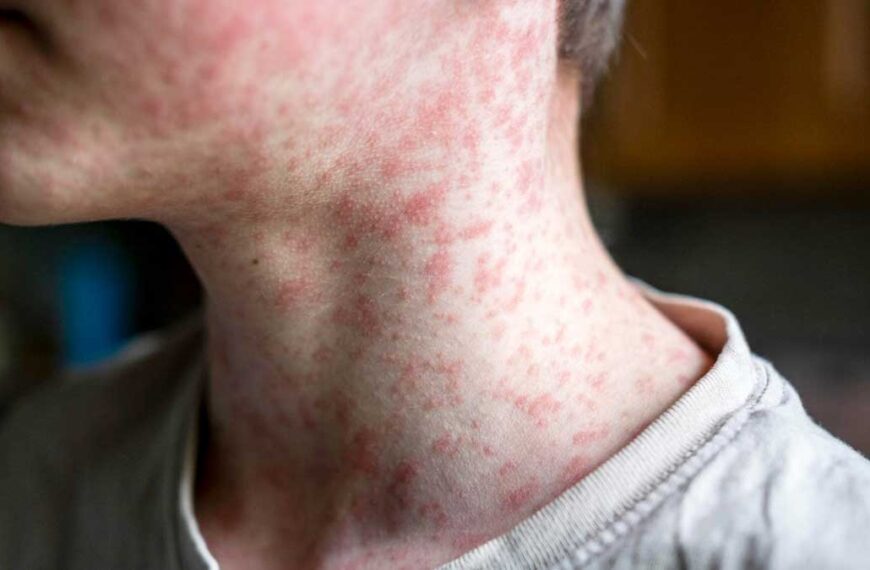 Alarmante brote de sarampión en Arizona